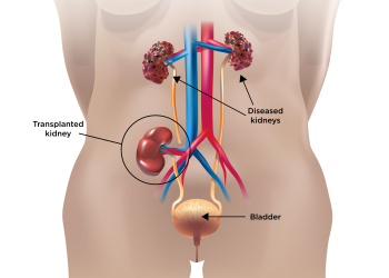 How Nasarawa’s hidden kidney trade targets desperate youth 