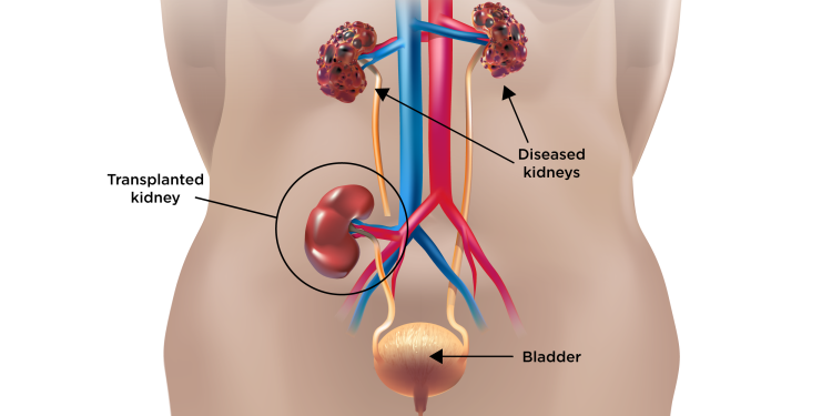 How Nasarawa’s hidden kidney trade targets desperate youth 